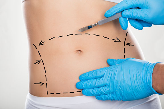 Abdominoplastik Gelsenkirchen